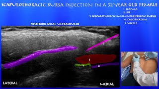 Ultrasound Guided Scapulothoracic Bursa Injection in a 32 Year Old Female by probeultrasoundcom [upl. by Egedan]