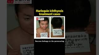 How has the harlequin ichthyosis been treated ichthyosis dryskin ichthyosisvulgaris fishskin [upl. by Eitnom]