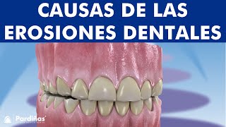 Abfracción atrición abrasión reabsorción dental y otros problemas de desgaste de los dientes © [upl. by Roee]