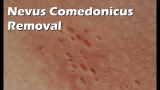 Nevus Comedonicus Removal  9 minutes worth [upl. by Parnell]