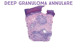 Deep Granuloma Annulare mimic of rheumatoid nodule amp epithelioid sarcoma Emory case 2 [upl. by Graniah594]