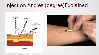 Injection Angles💉 degree Explained Intramuscular Subcutaneous Intradermal shorts [upl. by Ahsikram]