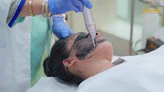 Carbon Laser Facial আন ইভেনটোন এবং মেলাজমার পারফেক্ট সমাধান  Skincare Treatment  BioXin [upl. by Nilya]