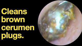 Cleans brown cerumen plugsear wax removal  ear cleaning  ASMR  relaxation  relax [upl. by Manville188]