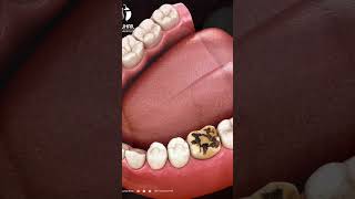 Souriez sans crainte  Tout ce que vous devez savoir sur lélimination des caries dentaires [upl. by Einahpehs961]