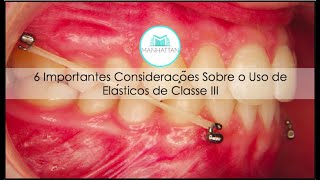 6 Importantes Considerações Sobre o Uso de Elásticos de Classe III  Produzido por Dolphin [upl. by Flowers]