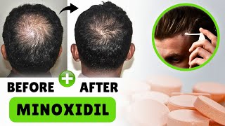 This is How I Restored my Hair loss In 3 Months [upl. by Iv942]