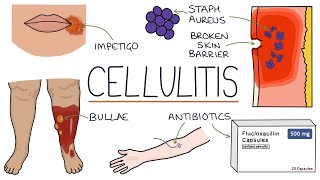 Understanding Cellulitis Skin and Soft Tissue Infections [upl. by Woody]