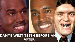 Kanye Wests SHOCKING 850K Titanium Teeth REVEALED😱🦷Dentist DENIES RumorsOutrage on Social Media [upl. by Anaitit273]