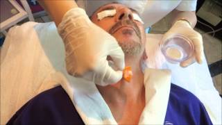 Virtual Mesotherapy Electroporation treatment [upl. by Oelc934]