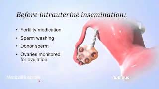 IUI Intra Uterine Insemination [upl. by Erdried]