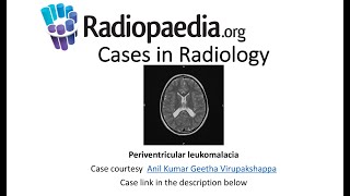 Periventricular leukomalacia Radiopaediaorg Cases in Radiology [upl. by Llerret]