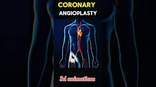 Coronary Angioplasty process shorts viral tranding coronary [upl. by Lobiv]