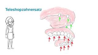 Teleskopzahnersatz  Was ist das  ein Erklärvideo [upl. by Essex]