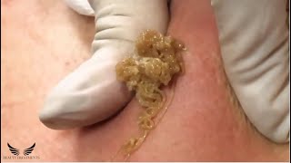 Severe Cystic Acne  Blackhead Whitehead Removal  Pimple Popping Spa Treatment  Elderly Acne 068 [upl. by Tadich]