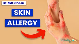 Skin Allergy  the best treatment for you skin Nightmare from a doctor A WARNING [upl. by Arehahs123]