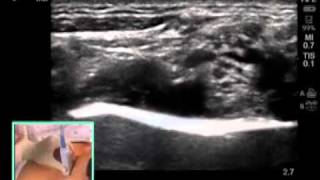 ULTRASOUNDGUIDED SUPRACLAVICULAR NERVE BLOCK [upl. by Ailey]