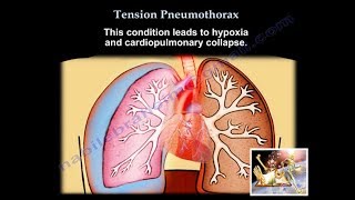 Tension Pneumothorax  Everything You Need To Know  Dr Nabil Ebraheim [upl. by Anaitsirc]