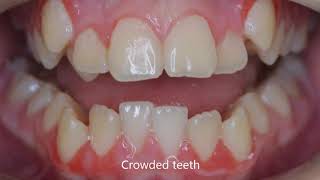 Fix crooked teeth and crossbite with braces [upl. by Collete]