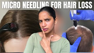 Microneedling for hair growth HINDI [upl. by Nihahs]