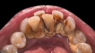 Crowding Teeth Will Increase Tartar Buildup  Scaling [upl. by Norramic640]