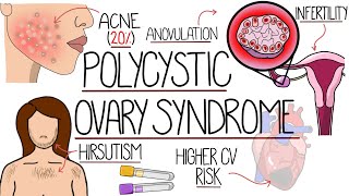 Polycystic Ovary Syndrome Made Easy PCOS Explained [upl. by Morril316]