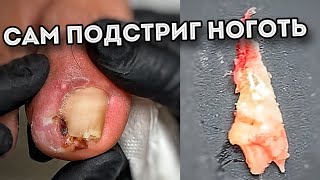 Попытки удалить вросший ноготь самостоятельно  результат 👍👎🏻 [upl. by Aitret902]