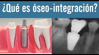 Qué es oseointegración  Juan Fernando Salgado  La oseointegración de los implantes dentales [upl. by Munafo]