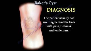 Bakers Cyst of the kneemeniscus tear arthritis of the knee [upl. by Gerkman324]