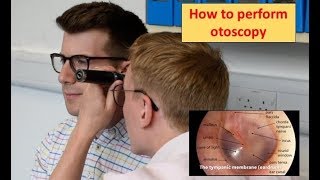 How to perform Otoscopy Ear Exam [upl. by Lovato938]