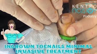 Ιngrown toenail feet κεντροποδιου foot podia calluses podiatrist corns footcare podiatrist [upl. by Ellehcen]