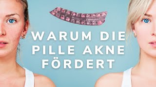 Was hilft gegen hormonelle Akne [upl. by Benedikt]