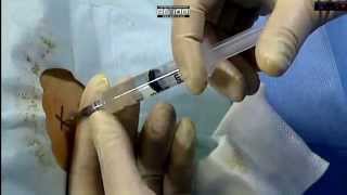 Paracentesis Abdominal Subtitulos en español [upl. by Anitsyrhk]