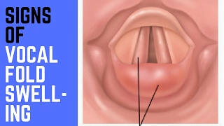 Signs of Vocal Fold Swelling [upl. by Shermy]