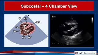 Guidelines for Performing a Comprehensive TTE in Adults Webinar [upl. by Tipton]