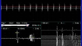 Myokymic discharges doublets triplets in facial nerve lesion [upl. by Broida987]