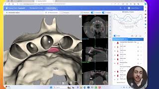 Assessment of buccal plate thickness from CBCT using AI [upl. by Akialam]