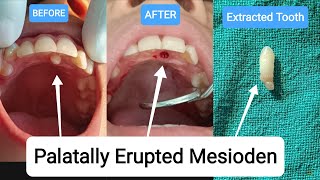 🇳🇵Extraction of Supernumerary Tooth Mesiodens Extra Tooth Exodontia Palatally Erupted nepal [upl. by Ledda]