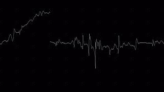 EMG myopathic vastus lateralis [upl. by Karalynn790]