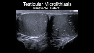 Testicular Microlithiasis [upl. by Aidul]