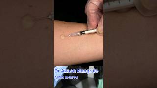 Mantoux Test  Tuberculin Skin Test doctor aiims neet academic mbbsmotivation [upl. by Tybald542]