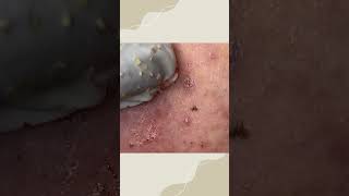 Big Cystic Acne Blackheads Extraction Blackheads amp Milia Whiteheads Removal Pimple Popping [upl. by Bernadine]