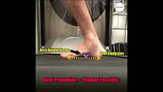 Over pronation is when your feet roll in too far [upl. by Ja]