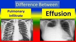 Difference between Pulmonary Infiltrate and Effusion [upl. by Etta]