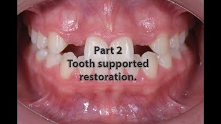 management of missed lateral tooth supported restoration [upl. by Violeta]