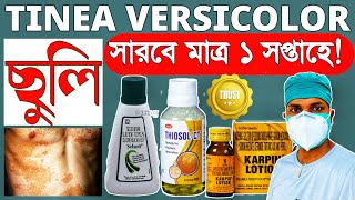 Tinea Versicolor TreatmentPityriasis Versicolor Treatmentছুলি দূর করার উপায় [upl. by Nirred]