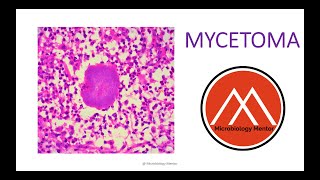 MYCETOMA Fungal infection 🔬🧫 Subcutaneous mycoses [upl. by Idnib]