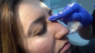 NonSurgical Nose Job NSNJ using Restylane [upl. by Alisander]