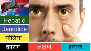 पीलियाJaundiceHepatic पीलिया के कारणलक्षण और इलाज की पूरी जानकारी ll Treatment of Jaundice ll [upl. by Atnohsal]