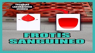 🩸¿Como Hacer un FROTIS SANGUÍNEO Extendido de Sangre Periférica 🔬Tutorial Laboratorio Clínico [upl. by Bobette]